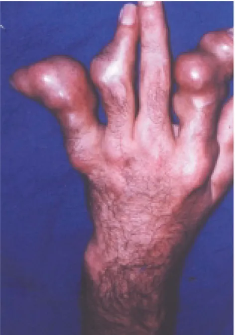 Şekil  2:  Hastanın  sol  elinin  preoperatif  radyolojik görünümü