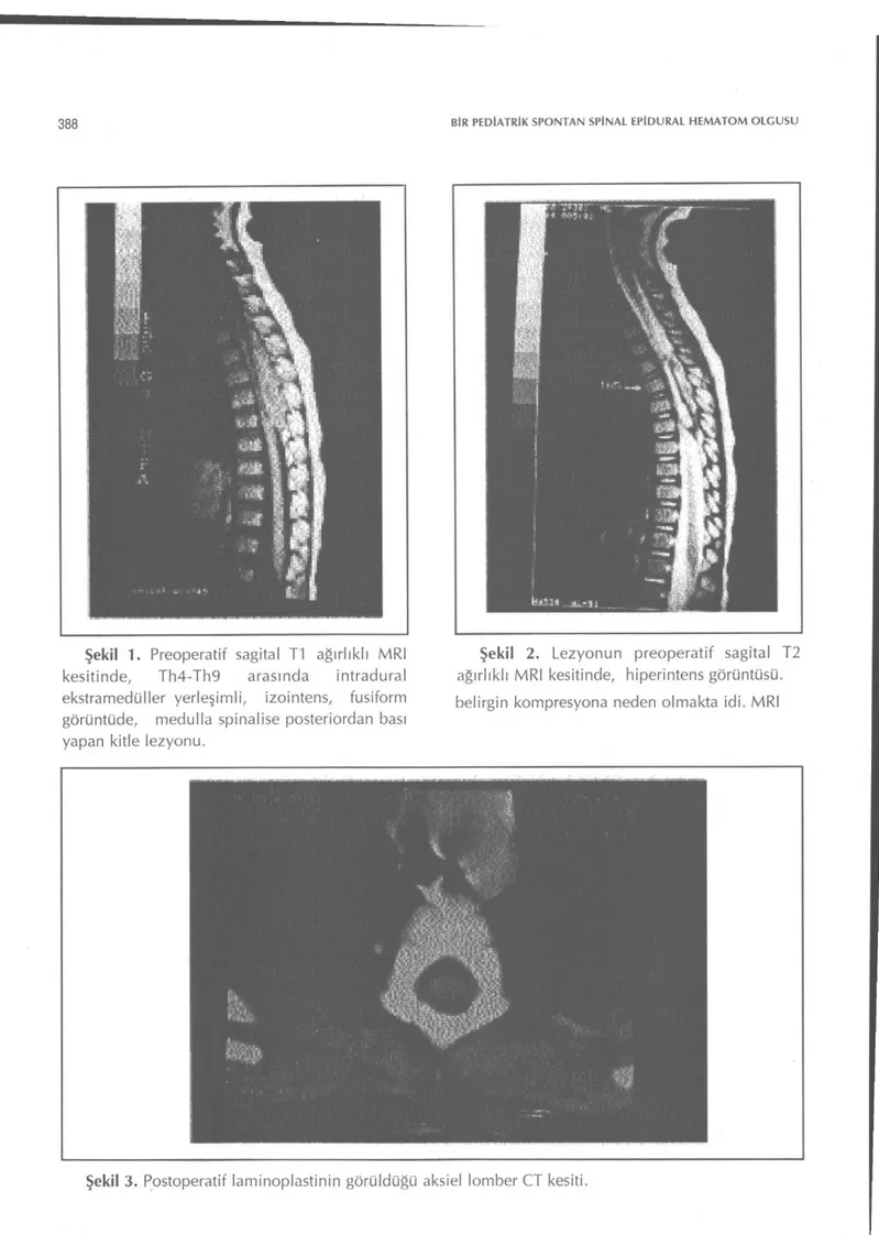 Şekil 1. Preoperatif sagital Tl ağırlıklı MRI 