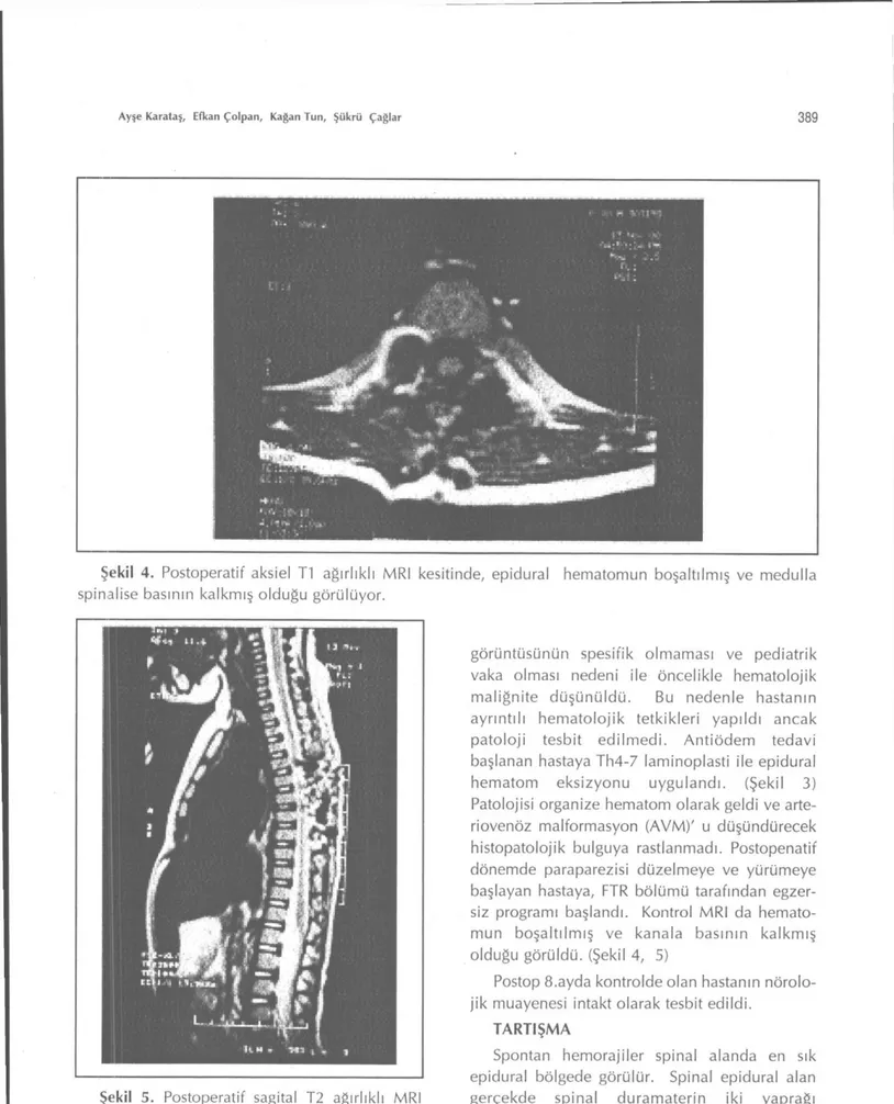 Şekil 4. Postoperatif aksiel Tl ağırlıklı MRI kesitinde, epidural hematomun boşaltılmış ve medulla  spinalise basının kalkmış olduğu görülüyor