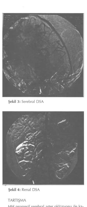 Şekil 3: Serebral DSA 