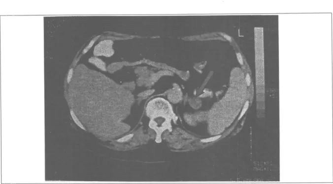 Şekil 1: Sol adrenal adenomun CT görünümü  Klinik olarak sessiz olan insidentalomaların  çapları 0.5 cm'den 6 cm ve daha büyük  boyutla-ra ulaşabilmektedir