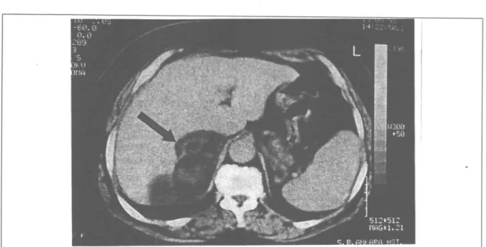 Şekil 2: Myelolipom olgusunun CT görünümü  motoraks, kanama, abse formasyonu gibi  kompli-kasyonlara sahiptir(15)