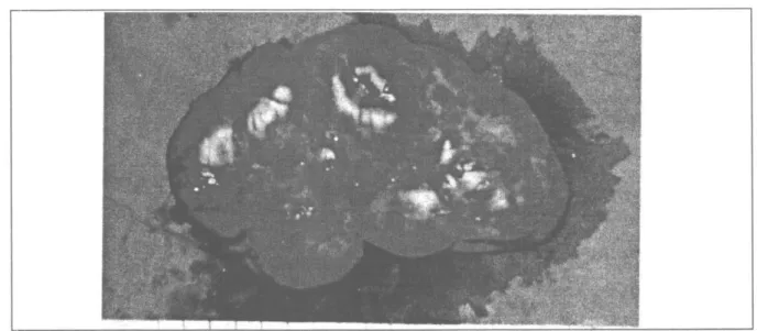 Şekil 3: Öpere edilen Myelolipom olgusunun makroskopik görünümü  dentalomalara yapılan CT sonucunda yağdan 