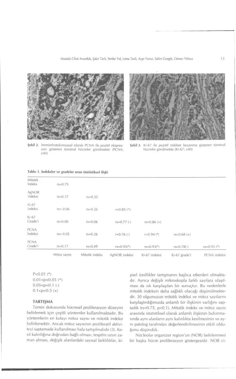 Şekil 2. immiinhistokimyasal olarak PCNA ile pozitif ekspres- Şekil 3. Kİ-67 ile pozitif nükleer boyanma gösteren tümöral 