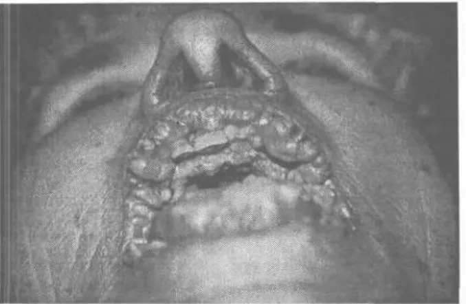 Şekil 5. Oral florid papillomatozisli ikinci olgunun erken post- post-operatif görünümü