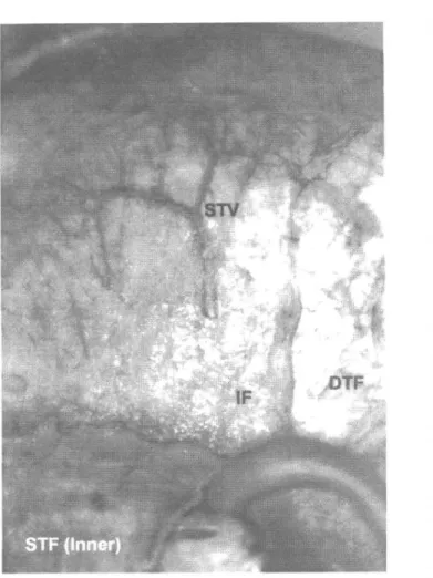 Şekil 1. A. temporalis superficialis'in (STV), İnnominate Fa- Fa-sia'ya (IF) süperficial temporal fasia'dan verdiği dallar,  Derin Temporal Fasia'nın üzerinde, temporal hat  civa-rında bir vasküler ark oluşturmak için seyrederler