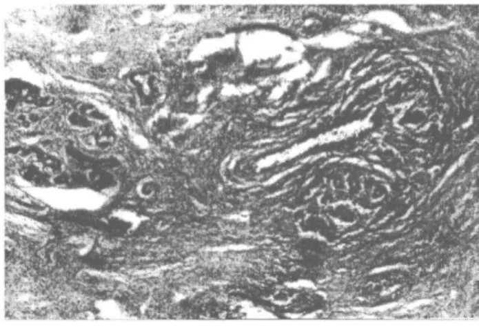 Şekil 3. Atipik lenfoid hücreler görülmekte (HE; x100). 