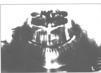 Şekil 6 Ameliyattan bir yıl sonraki pantomografik mandibula 