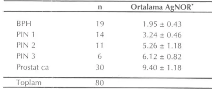 Tablo 2. BPH, PIN ve prostat ca gruplarında ortalama AgNOR  değerleriyle prostat spesifik antijen dansitelerinin  (PSAD) karşılaştırılması (n: Hasta sayısı) 