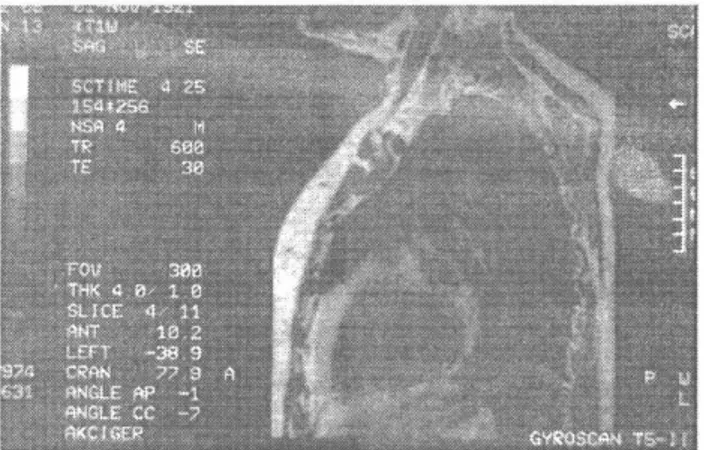 Şekil 2: Olgu l'e ait kitle lezyonunun toraks MRI görüntüsü  sonucu lenfanjioma tanısı konulan olgu, postoperatif  10