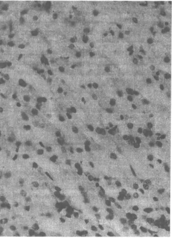 Şekil 1. Karaciğer biyopsisi,  P A S (+) materyal 