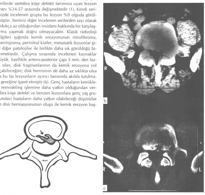 Şekil 2: (a) Şematik çizimde, aksiyel kesitte, vertebra korpus posteriorunda erezyon ve skleroza neden olan, fragmante disk  materyali (ok): Lomber posterior marjinal nodül