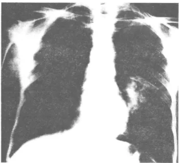 Şekil 1: PA Akciğer grafisinde sol parahiler kitle görünümü. 