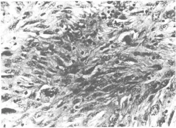 Şekil 4: Biceps kası içinde infiltrasyon gösteren, yer yer psö- psö-dosarkomatöz görünümde yassı epitel karsinomu  (HEx40)