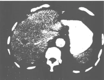 Şekil 3: Toraks BTde sağda posteriordaki kitle lezyon ile birlik- Şekil 4: Abdominal BTde karaciğerde metastaz ile uyumlu gö-