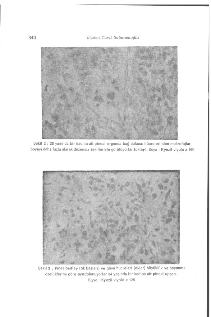 Şekil 2 : 28 yaşında bir kadına ait pineal organda bağ dokusu hücrelerinden makrofajlar  boyayı daha fazla alarak düzensiz şekilleriyle görülüyorlar (oklar)