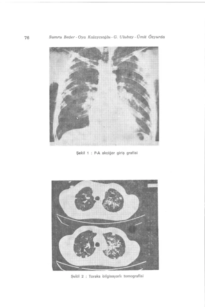 Şekil 2 : Toraks bilgisayarlı tomografisi 