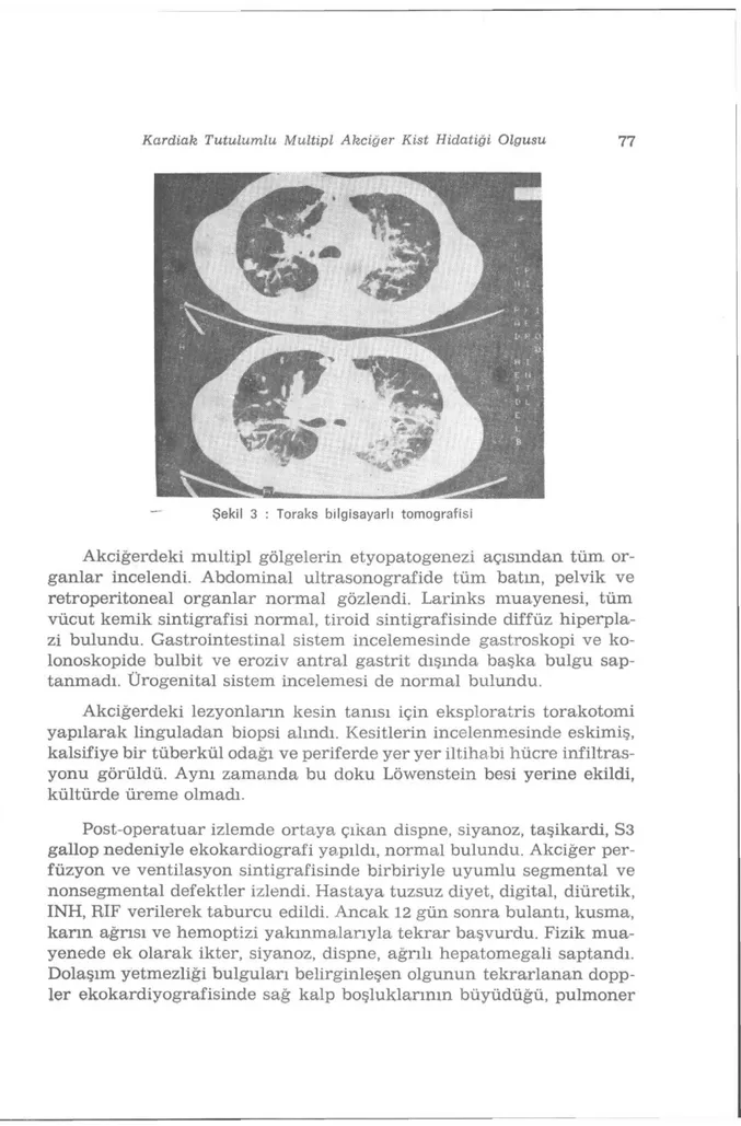 Şekil 3 : Toraks bilgisayarlı tomografisi 