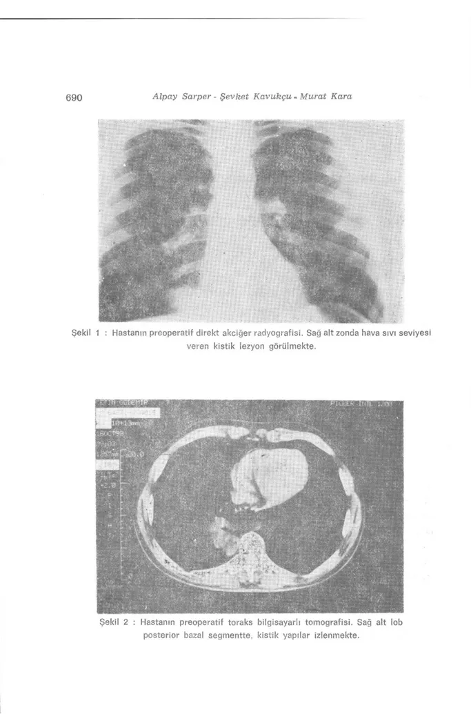 Şekil 1 : Hastanın preoperatif direkt akciğer radyografisi. Sağ alt zonda hava sıvı seviyesi  veren kistik lezyon görülmekte