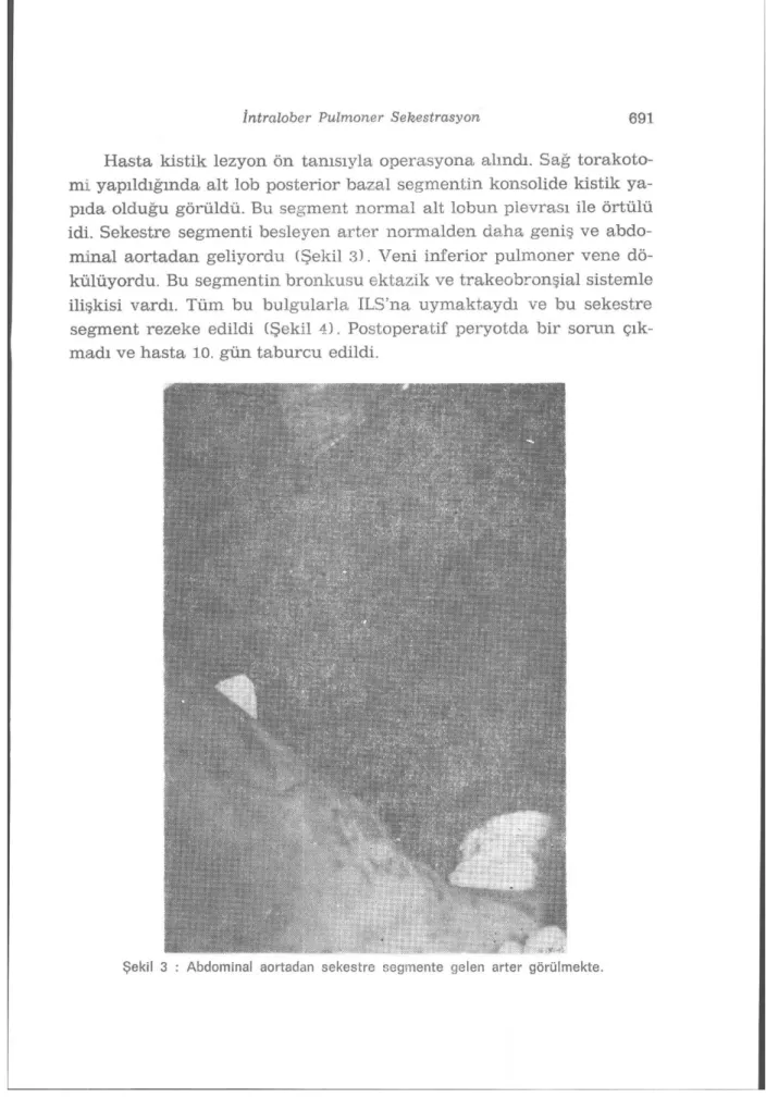 Şekil 3 : Abdominal aortadan sekestre segmente gelen arter görülmekte. 