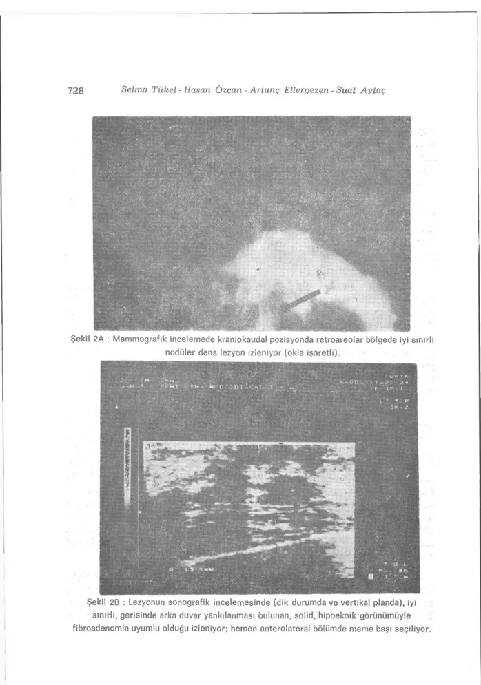 Şekil 2A : Mammografik incelemede kraniokaudal pozisyonda retroareolar bölgede iyi sınırlı  nodüler dens lezyon izleniyor (okla işaretli)
