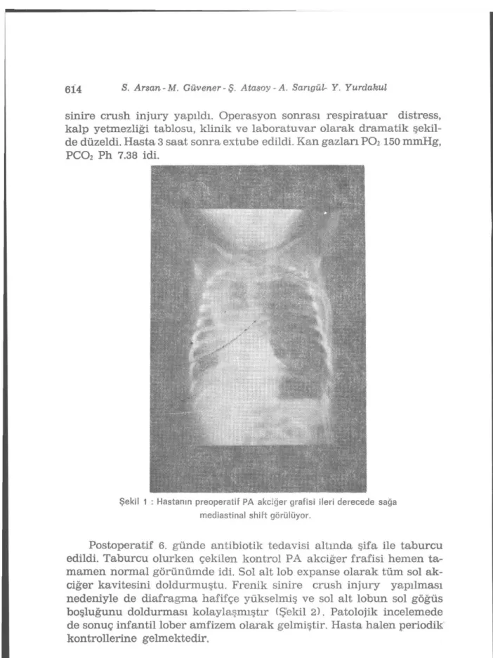 Şekil 1 : Hastanın preoperatif PA akciğer grafisi ileri derecede sağa  mediastinal shift görülüyor