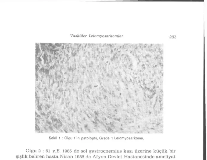 Şekil 1 : Olgu 1 &#34;in patolojisi, Grade 1 Leiomyosarkoma. 