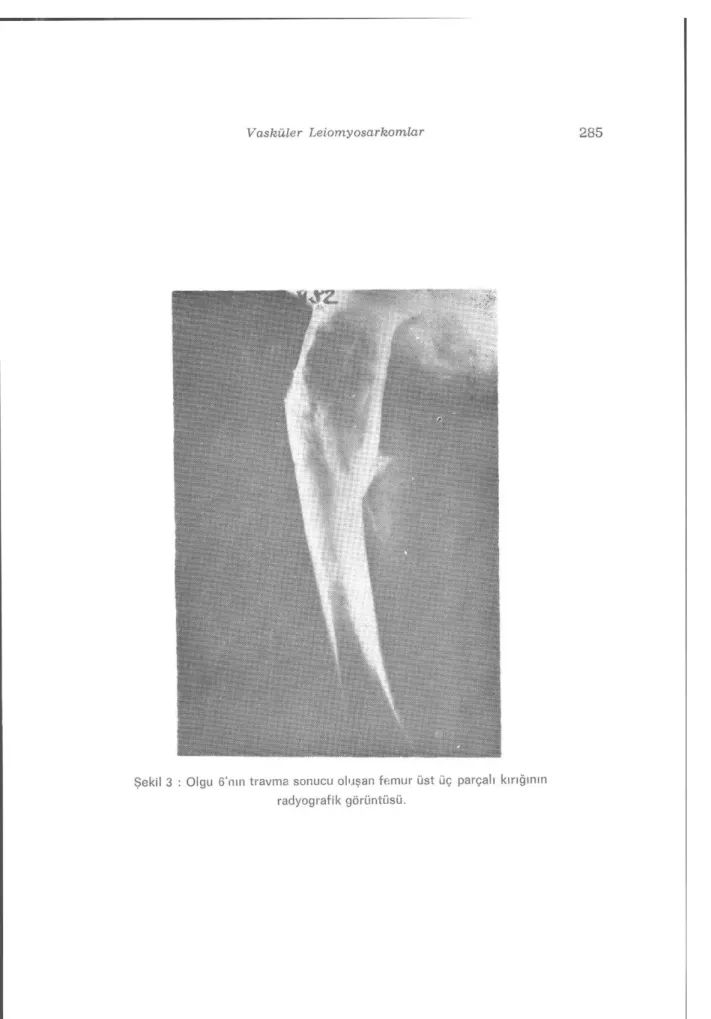 Şekil 3 : Olgu 6'nın travma sonucu oluşan femur üst üç parçalı kırığının  radyografik görüntüsü