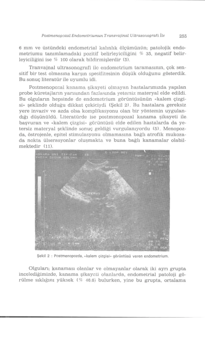 Şekil 2 : Postmenopozda, «kalem çizgisi» görüntüsü veren endometrium. 