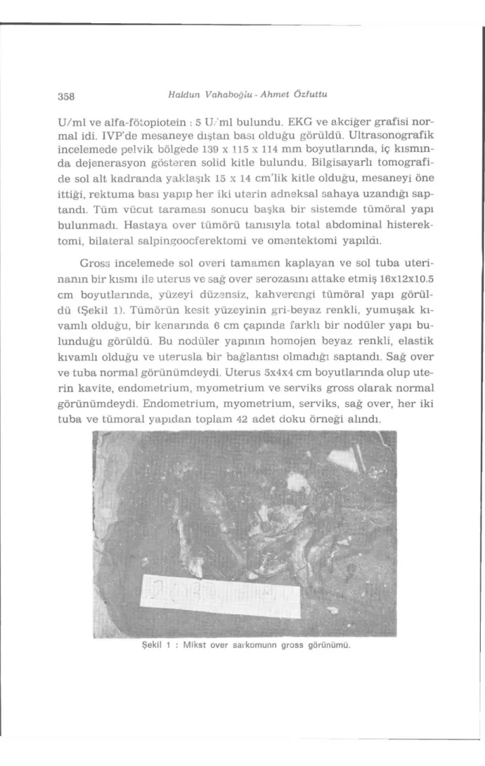 Şekil 1 : Mikst över sarkomunn gross görünümü. 