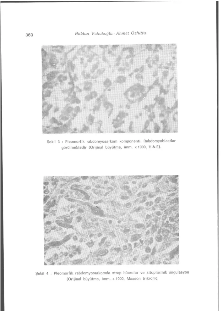 Şekil 4 : Pleomorfik rabdomyosarkomda strap hücreler ve sitoplazmik angulasyon  (Orijinal büyütme, imm
