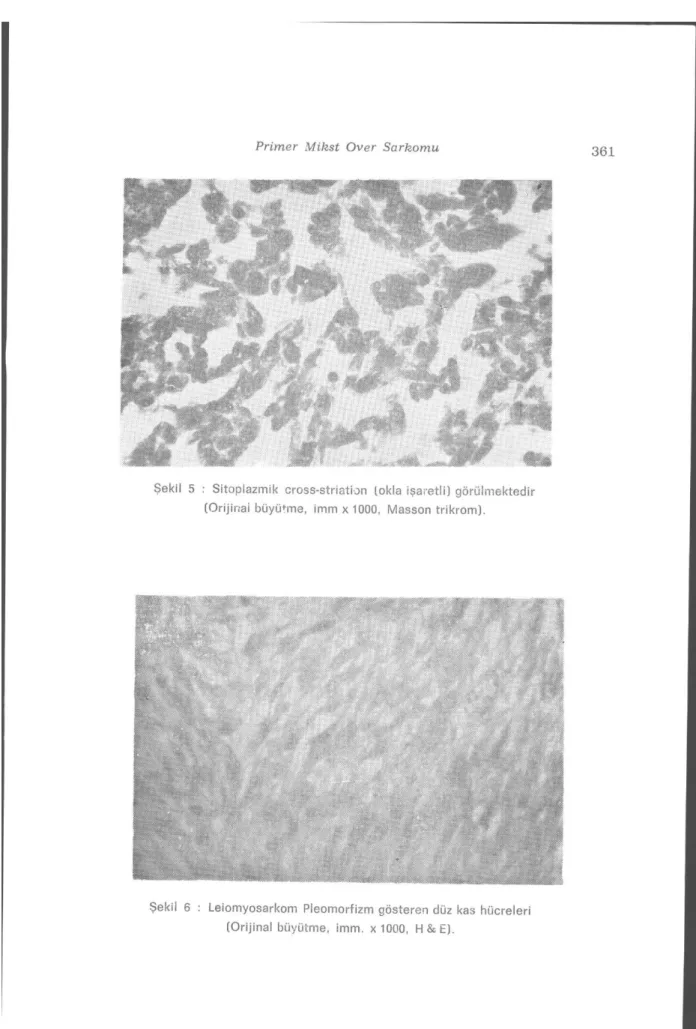 Şekil 5 : Sitoplazmik cross-striation (okla işaretli) görülmektedir  (Orijinal büyü+me, imm x 1000, Masson trikrom)