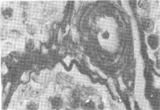 Şekil 5 : Deney grubunda ince duvarlı dar  çaplı seminifer tübüllerde jerminal epitel  hücreleri arasında çözülmeler (ok başı)  tü-bül lümeninde hücresel döküntüler (yıldız)  görülüyor