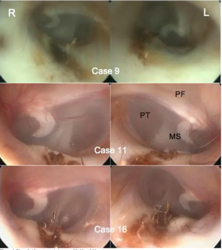 Figure 1. Normal video-otoscopic images of 9, 11 and 16 cases.  Şekil 1: Olgu 9, 11 ve 16’nın normal video-otoskopik görünümleri