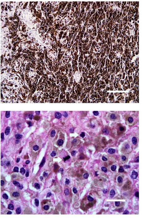 Figure  3.  Tumour  cells  containing  a  high  amount  of  melanin  pigment  (H&amp;E,  Bar=166  μm)