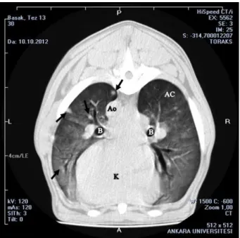 Figure  7.  Transverse  CT  image  at  the  level  of  tracheal  bifurcation in patient number 18 with thymoma