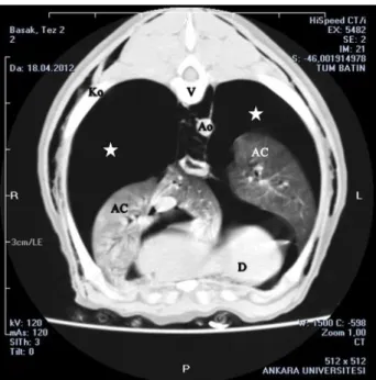 Figure  9.  Transverse  CT  image  at  level  of  the  7 th   thoracic  vertebra in patient number 2 with pneumothorax
