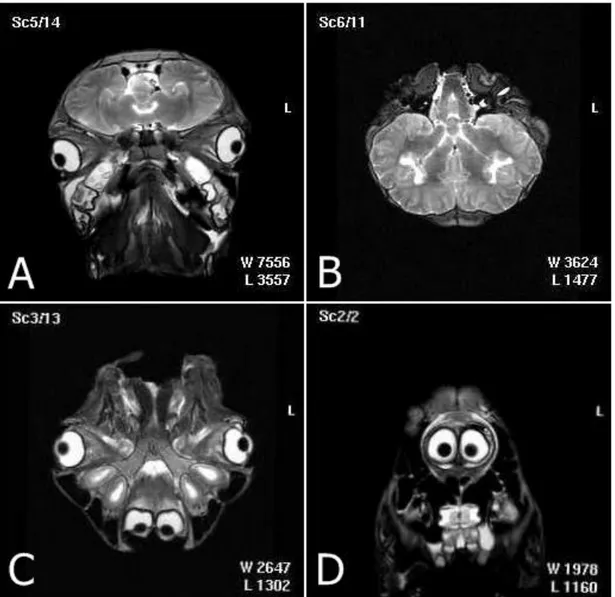 Şekil 1. A. Cavum cranii’de her iki beyine ait hemisferlerin görünümü, MR transversal kesit