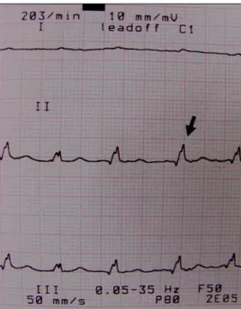 Figure 1: A low  voltage QRS (R wave: 0.5 mV; black arrow),  slight electrical alternans and atrial fibrillation in a dog with PE  due to dilated cardiomyopathy