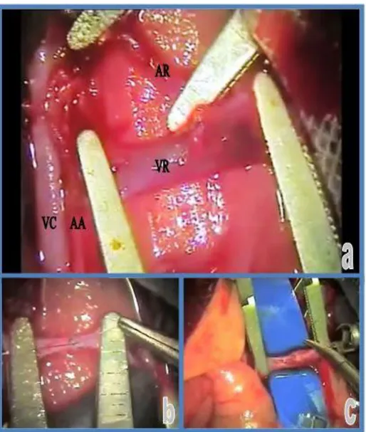 Figure  1.  a,  Double  clamp  approximators  were  applied  on  left  renal  artery  and  vein,  VR:  vena  renalis,  AR:  arteria  renalis,                        CV: inferior vena cava, AA: aorta abdominalis; b, Renal artery anastomosis; c, Renal vein a