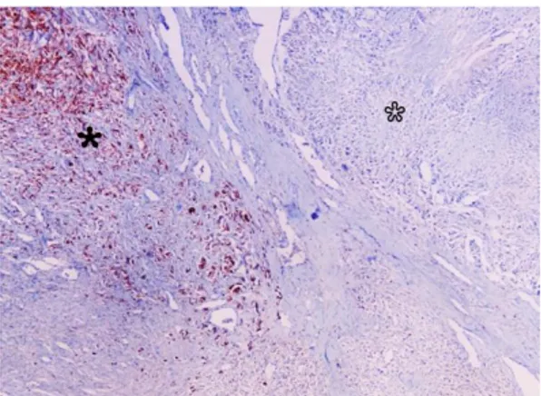 Figure 4. Melan-A immunoreactivity in the cellular components  of  conventional  melanoma  (black  asterisk)  in  contrast  to  those  of  neurosarcomatous  differentiation  region  (open  asterisk)