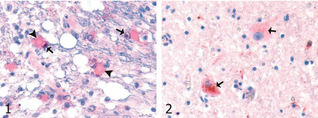 Şekil 1. Serebellumun beyaz maddesinde Köpek Gençlik Hastalığına ilişkin viral antijen immunopozitifliği (ok başları) ve bunlardan  bazılarında intranüklear inklüzyon cisimciklerindeki immunopozitiflik (oklar), SABP-AEC, x360