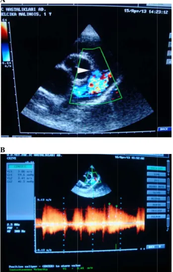 Figure 3: Righ flow Doppler  head) (A) and  (3.86 m/s) betw Şekil 3: Sağ Anormal penc pulmoner arte velositesinin ( on Color flo operative fr ejection fract detected ano Doppler flow tricuspid and ventricular se General combination  intratracheal  2% isofl