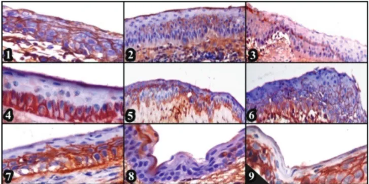 Figure 6. CK3-12 primary sera, Group 1, positive reaction in central cornea from basal cells throughout the suprabasal cells, x400,  ABC-P (1), K3-12 primer serum, Group 2, positivity of limbal basal cells from peripheral to central cornea, x400, ABC-P (2)