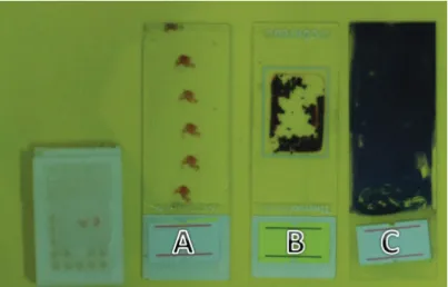 Figure 4.A) Cytocentrifugation of pleural fluid shows a mixed cell population including, macrophages, leucocytes and mesothelial  cells (PAP)