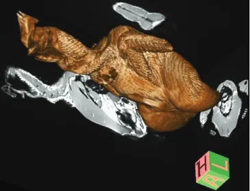 Figure 2. A 3D reconstructed, reformatted, colored, and volume  rendered T1W image sample