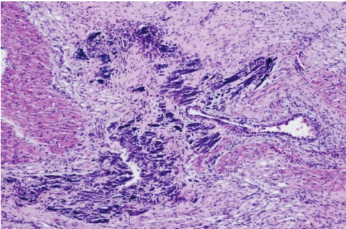 Figure 1. Accumulation of calcium due to necrosis in heart  muscle cells. 20, HXE 