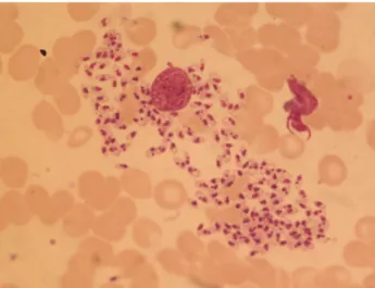 Figure 1: Bone marrow aspirate smear; Leishmania sp. within  reticulo-endothelial macrophage
