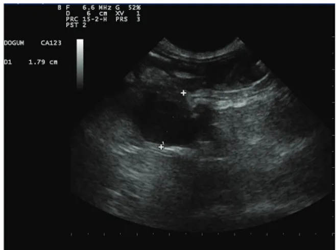 Figure 1. Ultrasonogram of the infected uterine horn.   Şekil 1. Enfekte edilmiş olan cornu uterinin ultrasonografisi