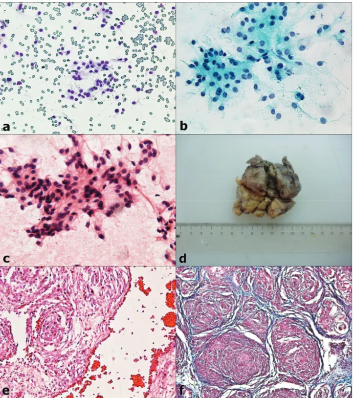 Şekil 1: Neoplazik perisitlerin sitolojik görüntüleri: a: MGG x200, b: PAP x400, c: HE x400 ; d: Kitlenin dış görünüşü ; e: Histopatolojideki  neoplazik iğsi perisitlerin tarafından parmak izi görünümü, HE x 200 ; f: Hemangioperistoma, Masson’un trikrom bo